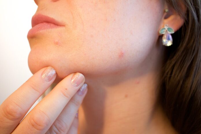 crema per acne con antibiotico